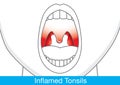 Showing Inflamed tonsils.