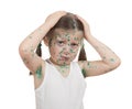 Sick child. chickenpox Royalty Free Stock Photo