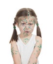 Sick child. chickenpox Royalty Free Stock Photo