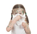 Sick child. chickenpox Royalty Free Stock Photo