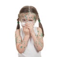 Sick child. chickenpox Royalty Free Stock Photo