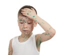 Sick child. chickenpox Royalty Free Stock Photo