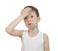 Sick child. chickenpox Royalty Free Stock Photo