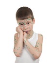 Sick child. chickenpox Royalty Free Stock Photo