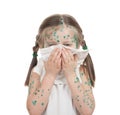 Sick child. chickenpox Royalty Free Stock Photo