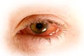 sick eye with Conjunctivitis