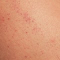sick human skin texture covered with red allergic spots and irritations Royalty Free Stock Photo