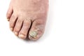 Sick nail on the foot. Toenail fungus isolated on white. Sore toenail, nail fungus close up photo Royalty Free Stock Photo