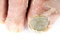 Sick nail on the foot. Toenail fungus isolated on white. Sore toenail, nail fungus close up photo Royalty Free Stock Photo