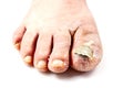 Sick nail on the foot. Toenail fungus isolated on white. Sore toenail, nail fungus close up photo Royalty Free Stock Photo