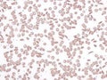 Sickle cell disease, peripheral blood. Royalty Free Stock Photo