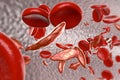 Sickle cell anemia