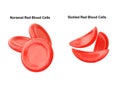 Sickle cell anemia is a hereditary disease characterized by the alteration of red blood cells, making them look like a sickle Royalty Free Stock Photo