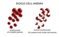 Sickle cell anemia Royalty Free Stock Photo