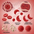 Sickle cell anemia includes crescent-shaped RBCs, indicating deformatio Royalty Free Stock Photo