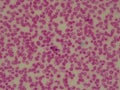 Sickle cell anemic blood under microscope. Red blood cells Royalty Free Stock Photo