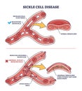 Sickle cell disease with abnormal red blood cell shape outline diagram