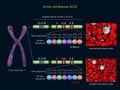 Sickle cell disease mutation