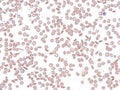 Sickle cell disease, peripheral blood. Royalty Free Stock Photo