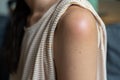 Side effect of the vaccine - shoulder skin redness and pain. Covid-19 vaccination reaction. Woman skin itchy and