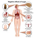 Side effects of sugar on the human body 3d medical illustration