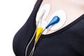 Side view of electrodes of Holter monitor on chest