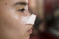 Side view of a female patient fresh from a rhinoplasty procedure. Nose covered with bandage