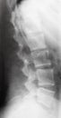 View of human spine on X-ray image Royalty Free Stock Photo