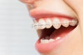 Orthodontics correction of jaws with clear bracket Royalty Free Stock Photo