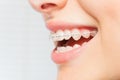Woman`s smile with clear dental braces on teeth Royalty Free Stock Photo