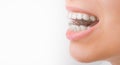 A side view of a womans smile in transparent and removable aligners with copy space Royalty Free Stock Photo