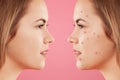 Sideways shot of two female`s faces: one with healthy pure skin and other with many pimples, has acne, constrast bewtween healthy