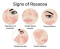 Signs of Rosacea