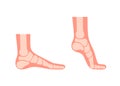 Silhouette human foot with bones, orthopedic leg, healthy feet. Full foot and tiptoe. Foot normal, flat foot. Supination