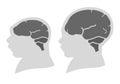 Silhouette image of the head and skull of a newborn child with a normal cranium and with microcephaly and severe microcephaly.