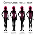 4 silhouettes of a female figure. Types of curvature of human legs. Vector image Royalty Free Stock Photo