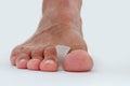 Silicone toe separator for bunion toe or hallux valgus. Royalty Free Stock Photo