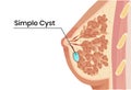 Simple breast cyst anatomy illustration