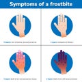 Simptoms of a frostbite. 4 medical stages. Infographic