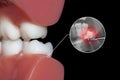 Simulation of wisdom tooth surgical extraction Royalty Free Stock Photo