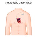 Single lead pacemaker placement. Cross section of heart and artificial cardiac pacemaker