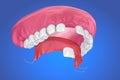 Single Missing Tooth - Removable partial denture