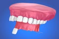 Single Missing Tooth - Removable partial denture