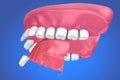 Single Missing Tooth - Removable partial denture . illustration