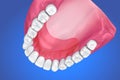 Single Missing Tooth - Removable partial denture