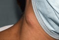 Single swelling or lymph node at the neck Royalty Free Stock Photo