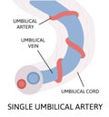 Single umbilical artery. anatomy of umbilical cord with one umbilical artery and one umbilical vien