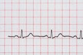 Sinus Heart Rhythm On Electrocardiogram Record Paper Showing Normal Heart