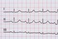 Sinus Heart Rhythm On Electrocardiogram Record Paper Showing Normal Heart