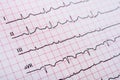 Sinus Heart Rhythm On Electrocardiogram Record Paper Showing Normal Heart